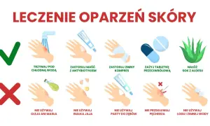 Co na oparzenie olejem? Chłodna woda, maść z antybiotykiem, zimny kompres, tabletki przeciwbólowe, sok z aloesu. Nie używaj oleju, masła, białka jaja, pasty do zębów, lodu.
